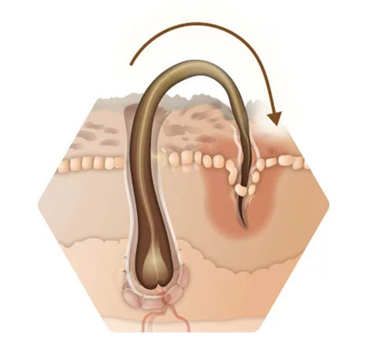 How to Prevent Ingrown Hairs After Body Hair Removal