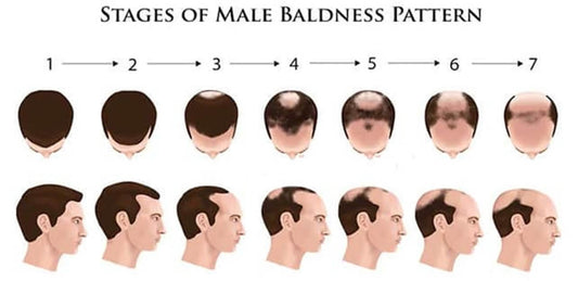 Understanding Male Pattern Baldness: Causes and Solutions