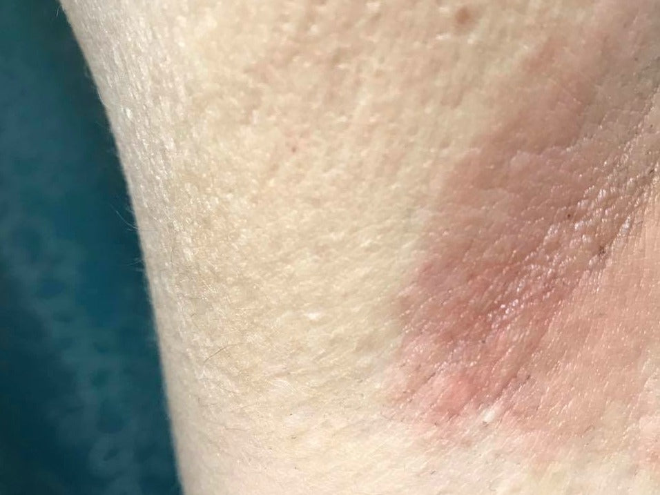 Dealing with Rash After Shaving Arms