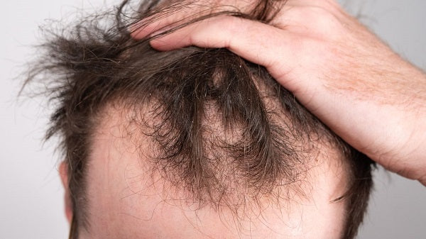 How to get medicine for men's hair loss