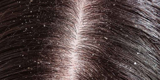 How to Prevent Dandruff from Coming Back After Using Anti-Dandruff Shampoo
