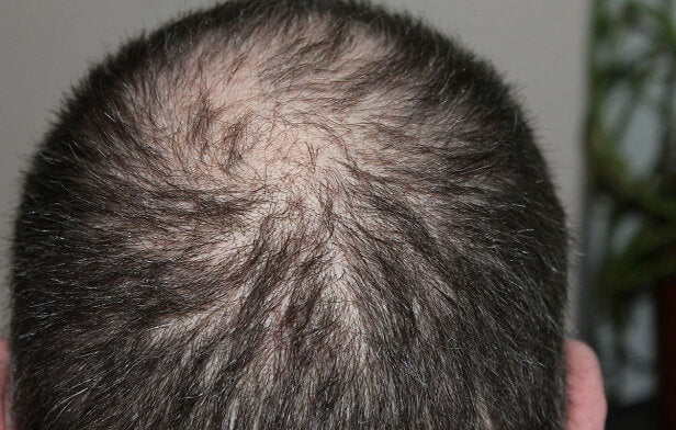 man with thinning hair
